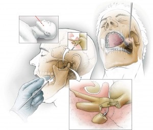 Nevralgia cauzelor și tratamentul nervului trigeminal