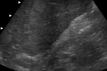 Norma glandei tiroide prin interpretarea cu ultrasunete a parametrilor, volumul normal