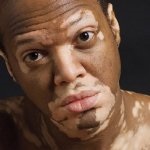 Cele mai noi metode de tratare a vitiligo - medicul dvs. aibolit