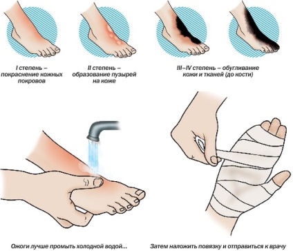 Degeraturi ale membrelor - prim ajutor, semne și caracteristici ale degerăturilor