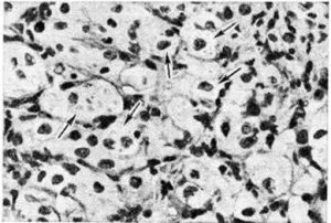 Oncocytoma - rákkezelés Izraelben, izraeli Rákközpont №1