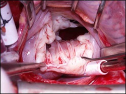 Szívsebészeti műtét - Berlin szívközpont - szívsebészeti műtét