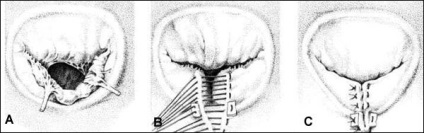 Supravegherea cardiacă - Centrul cardiac din Berlin - chirurgie cu valvă cardiacă