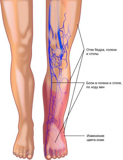 Az alsó végtagok thrombophlebitis szövetei, trombanet