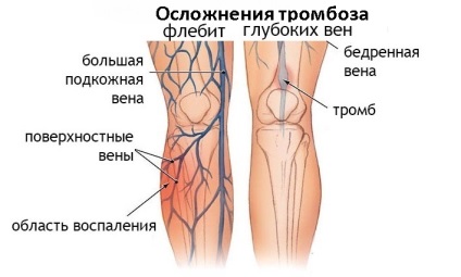 Az alsó végtagok thrombophlebitis szövetei, trombanet