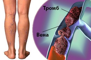 Az alsó végtagok thrombophlebitis szövetei, trombanet