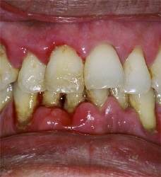Parodontita, paradontoza, gingivita, sângerarea gingiei, inflamația gingiilor, un factor determinant al bolilor,