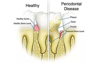 Parodontitis (periodontális betegség), illóolajok, élet