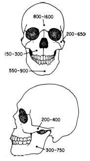 Fracturile sinusului frontal