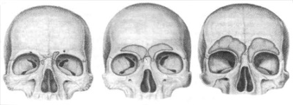 Fractura sinusului frontal - simptome, prim ajutor și tratament