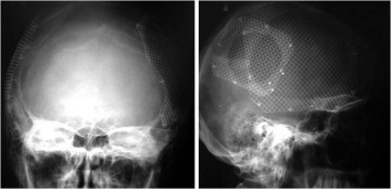 Plasticitatea defectelor oaselor craniului