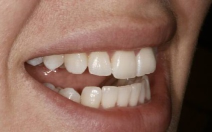 Umplerea dinților frontali care ar trebui să fie etanșați mai bine, materialul