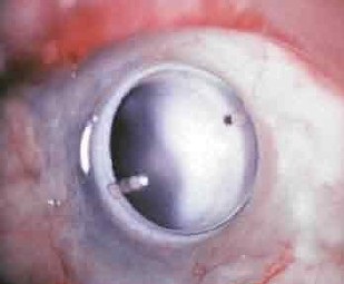 Keratoplastia stratificată