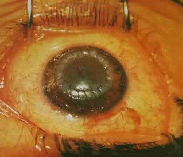 Keratoplastia stratificată