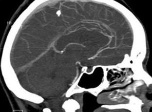 Megelőző encephalopathia okok és kezelés, a fej egészsége