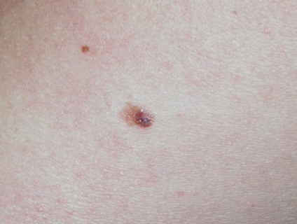 Simptomele melanomului superficial, cum să tratezi ce trebuie să faci, caracteristicile, prognosticul