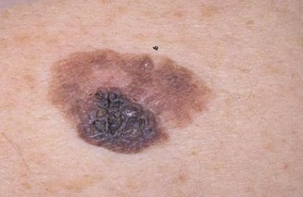 Felszíni melanoma jelek, a fejlődés okai, a kezelés módjai