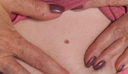 Felszíni melanoma jelek, a fejlődés okai, kezelési módszerek (melanoma) Felszíni melanoma jelek, a fejlődés okai, a kezelés módjai