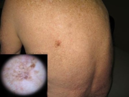 Felszínes melanoma tünetek, a fejlődés okai, a kezelés módjai (okai) Felszíni melanoma jelek, a fejlődés okai, a kezelés módjai