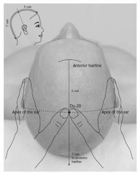 Element dispozitiv, acupunctura, acupunctura