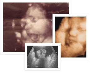 Cauza morții unui copil în uter, un făt în uter