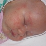 Cauzele și tratamentul transpirației la nou-născut