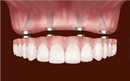 Aplicarea mini-implanturilor în stomatologie, instalare și îngrijire