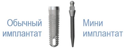 Mini-implantátumok alkalmazása a fogászat, a telepítés és a gondozás területén