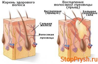 Acnee pe cap, în păr mai multe modalități de tratare urgentă