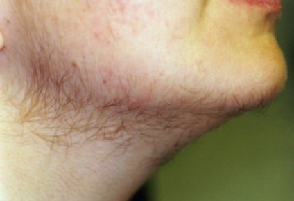 A problémás bőr a rák egyik jele