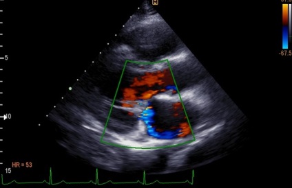 Prolapsul valvei mitrale la simptomele copiilor