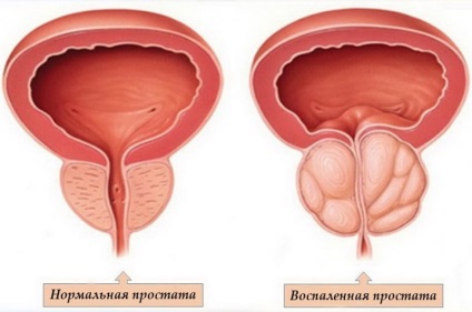 Prostatita provoaca boli, simptome si tratament