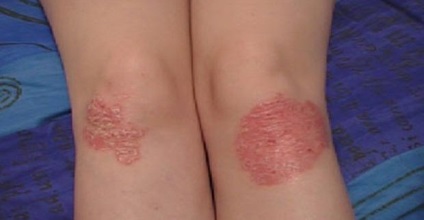 Psoriasis kezelés gyógynövényekkel, fűszernövények, főzetek, infúziók