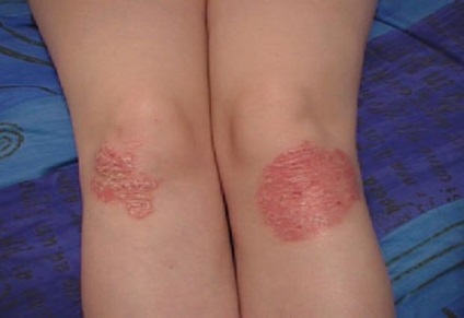 Psoriasis kezelés gyógynövényekkel, fűszernövények, főzetek, infúziók