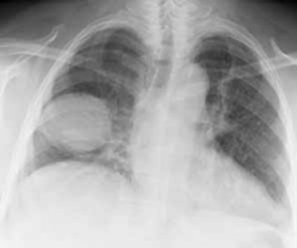 Cancerul pulmonar pe raze X - cum să îl recunoști și ce să faci