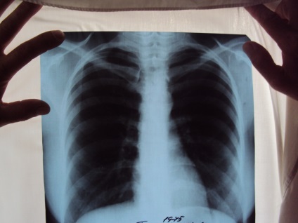Cancerul pulmonar pe raze X - cum să îl recunoști și ce să faci