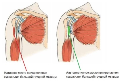 Ruptura musculara pectorala mare, fotografii inainte si dupa, interventii chirurgicale, recenzii, tratament, reabilitare si