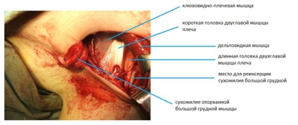 Ruptura musculara pectorala mare, fotografii inainte si dupa, interventii chirurgicale, recenzii, tratament, reabilitare si