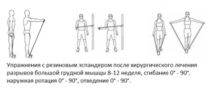 Ruptura musculara pectorala mare, fotografii inainte si dupa, interventii chirurgicale, recenzii, tratament, reabilitare si