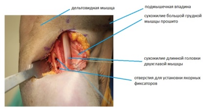 Nagy pectoralis izomtörés, fotók előtt és után, műtét, felülvizsgálat, kezelés, rehabilitáció és