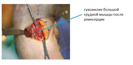Ruptura musculara pectorala mare, fotografii inainte si dupa, interventii chirurgicale, recenzii, tratament, reabilitare si
