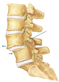 Retrovisteza vertebrelor - cauze, simptome, tratament