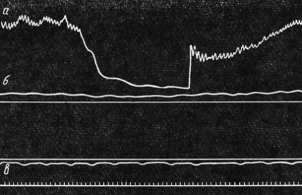 Insuficiență cardiacă 1965 alpern