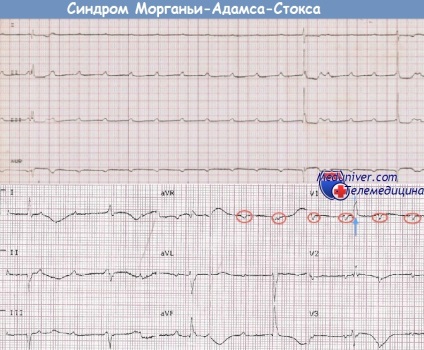 Sindromul Morgagni-adams-Stokes (morgagni-adams-stokes) - sinonime, autori, clinici