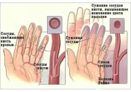 Sindromul Reynaud - cauze, simptome, diagnostic și tratament