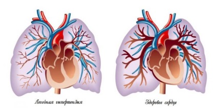 Sindromul Reynaud - cauze, simptome, diagnostic și tratament