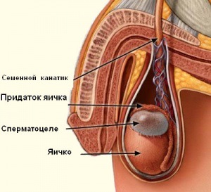 Spermatocele (apendice la chisturi ale testiculului)