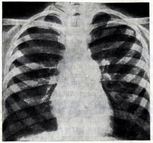 Stenoza codului arterei pulmonare cu μB 10 și cât de periculoasă este