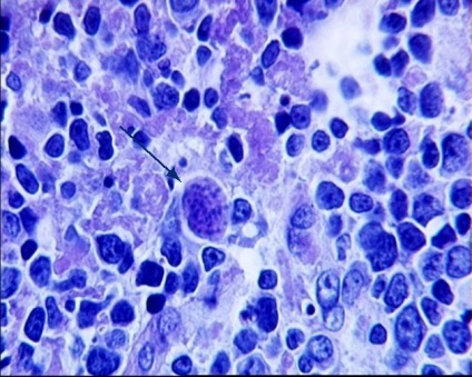 Toxoplasmosis gondii mi ez a tünet és kezelés, egy parazita fénykép (toxoplasmosis) Toxoplasmosis gondii mi olyan tünet és kezelés, egy parazita fénykép