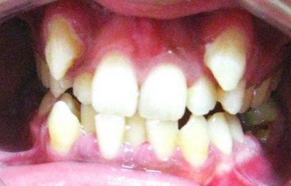 Trainer pentru dinți - o revoluție în ortodonție